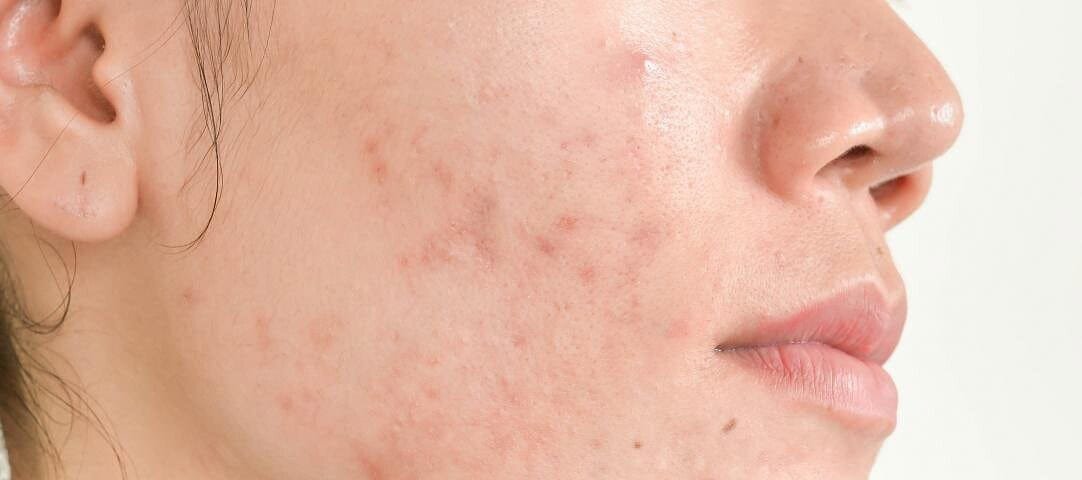 Acne duratura