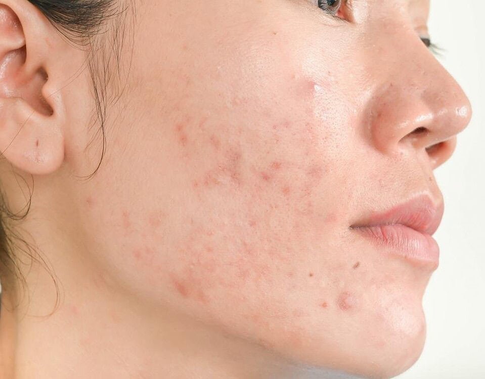 Acne duratura