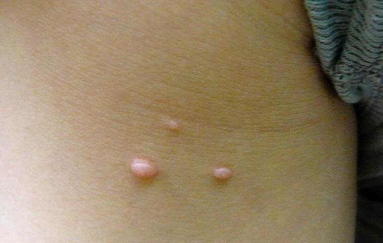 Dermatologo per rimozione molluschi