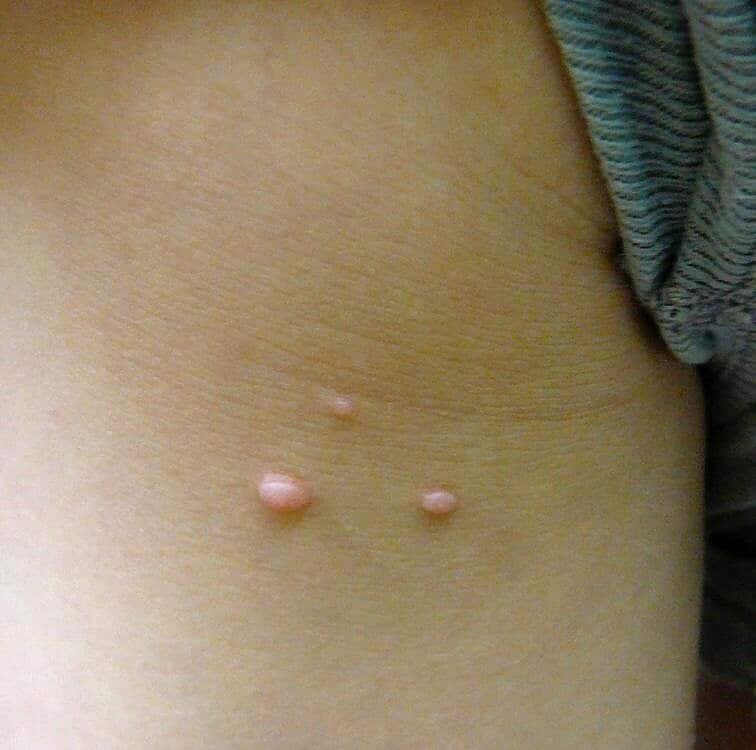 Dermatologo per rimozione molluschi