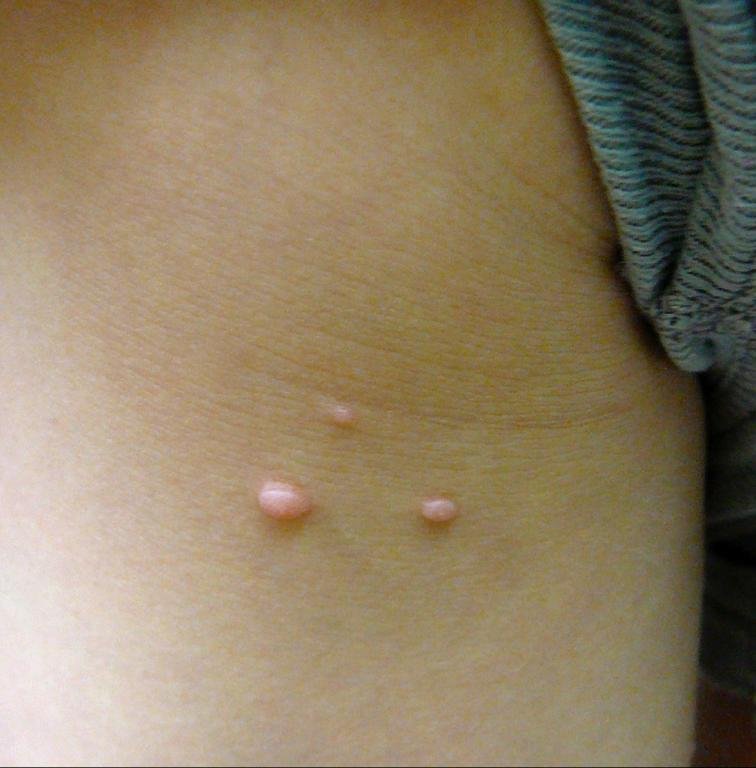 Dermatologo per rimozione molluschi