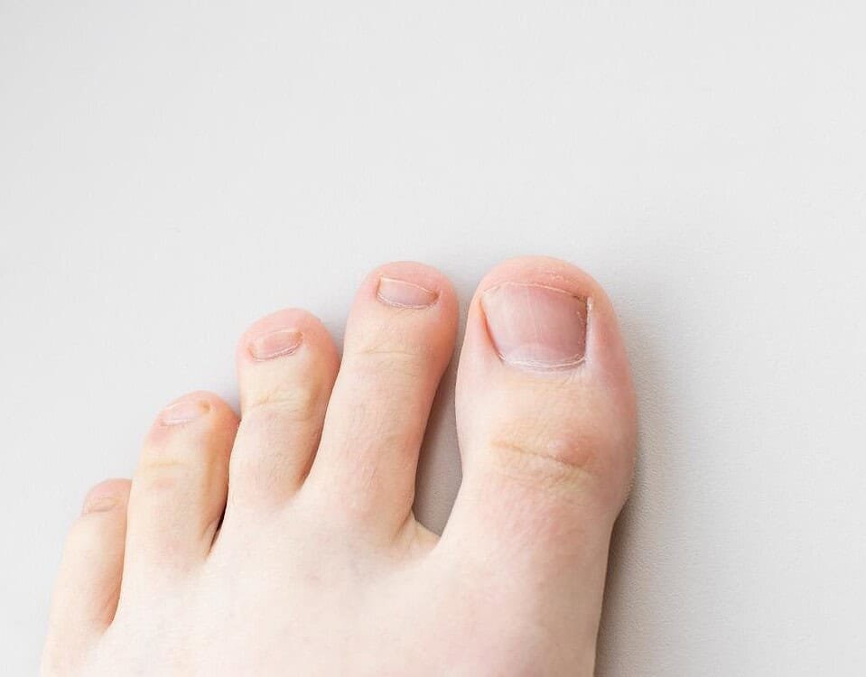 Micosi ai piedi