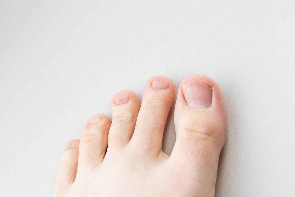 Micosi ai piedi