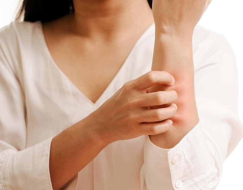 Orticaria