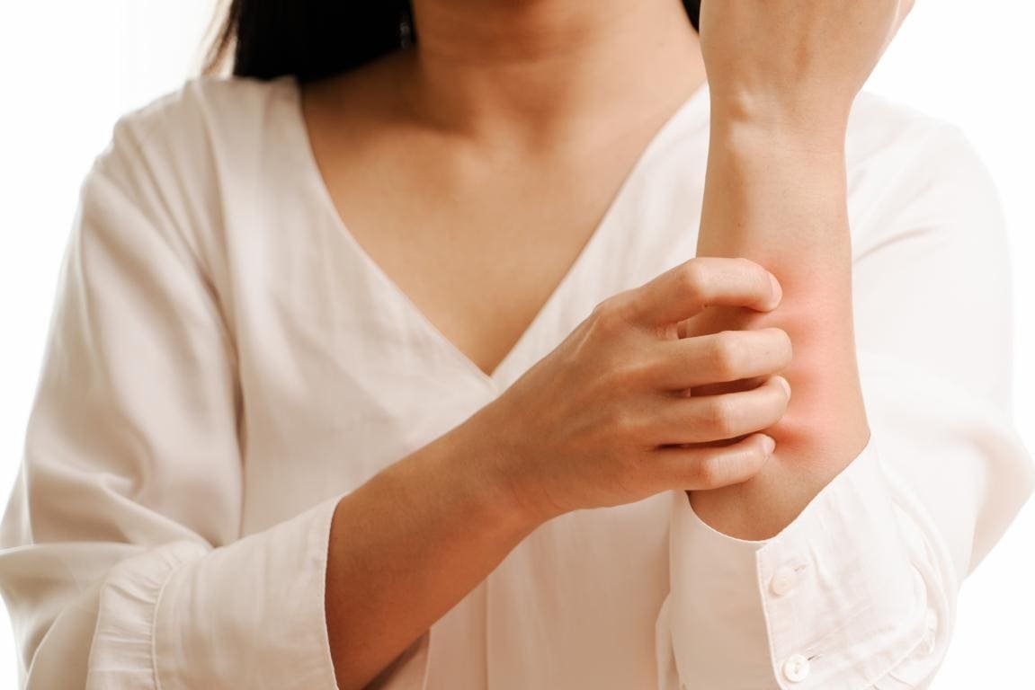 Orticaria
