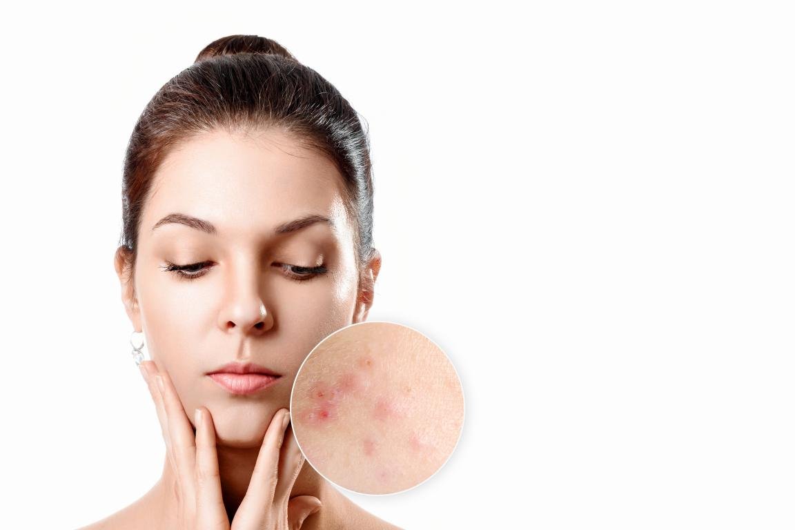 Tipologia di acne
