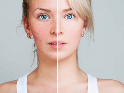 IMG-Acne-rosacea
