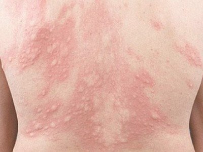 IMG-Orticaria