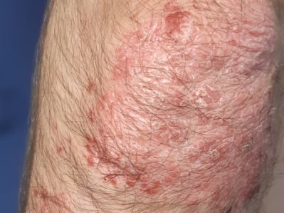 psoriasi-e1581934517829