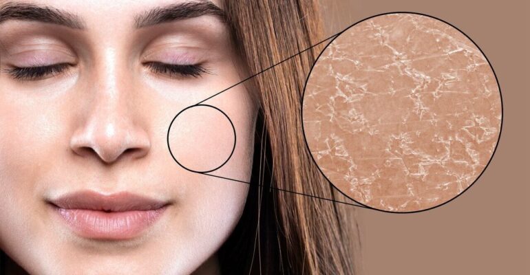 large-main_magnified_dry_skin