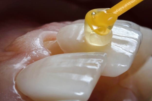 Five Things to Know Before Getting Porcelain Veneers