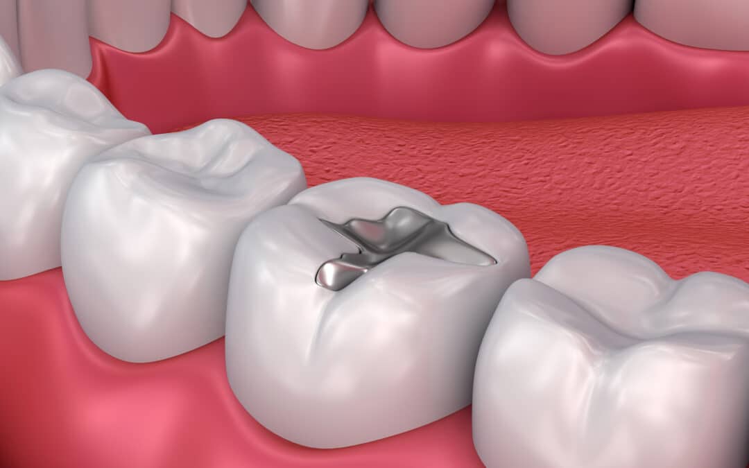 Metall dental fillings, Medically accurate 3D illustration