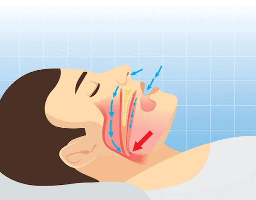 Demystifying the Connection Between Sleep Apnea And Snoring 