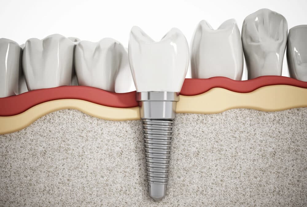How Dental Implants Keep Your Jawbone Strong and Healthy