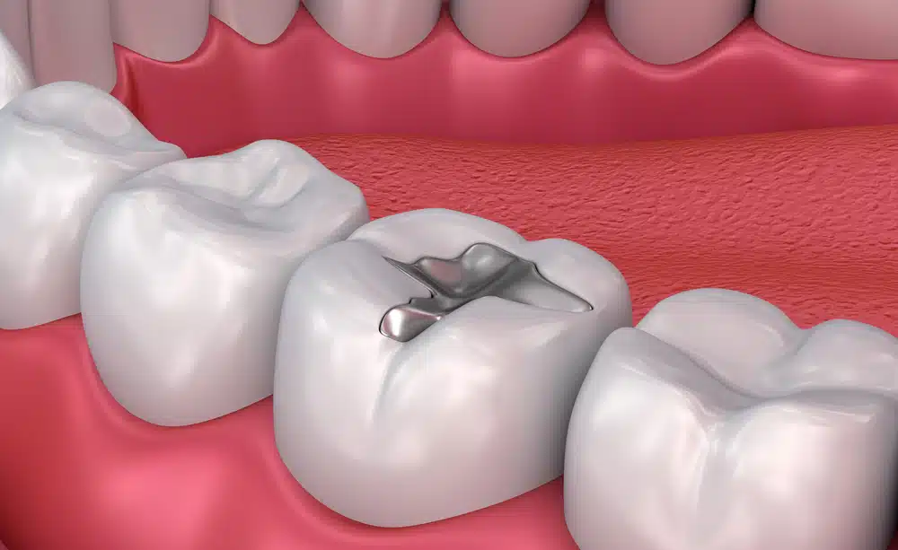 metal dental fillings