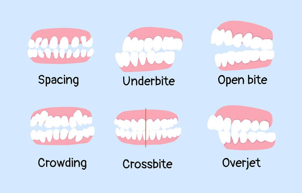 Can Invisalign® Fix Bite Problems or Just Crooked Teeth?