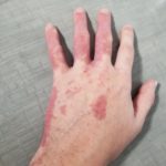 Macchie Cutanee - ALMA LASER