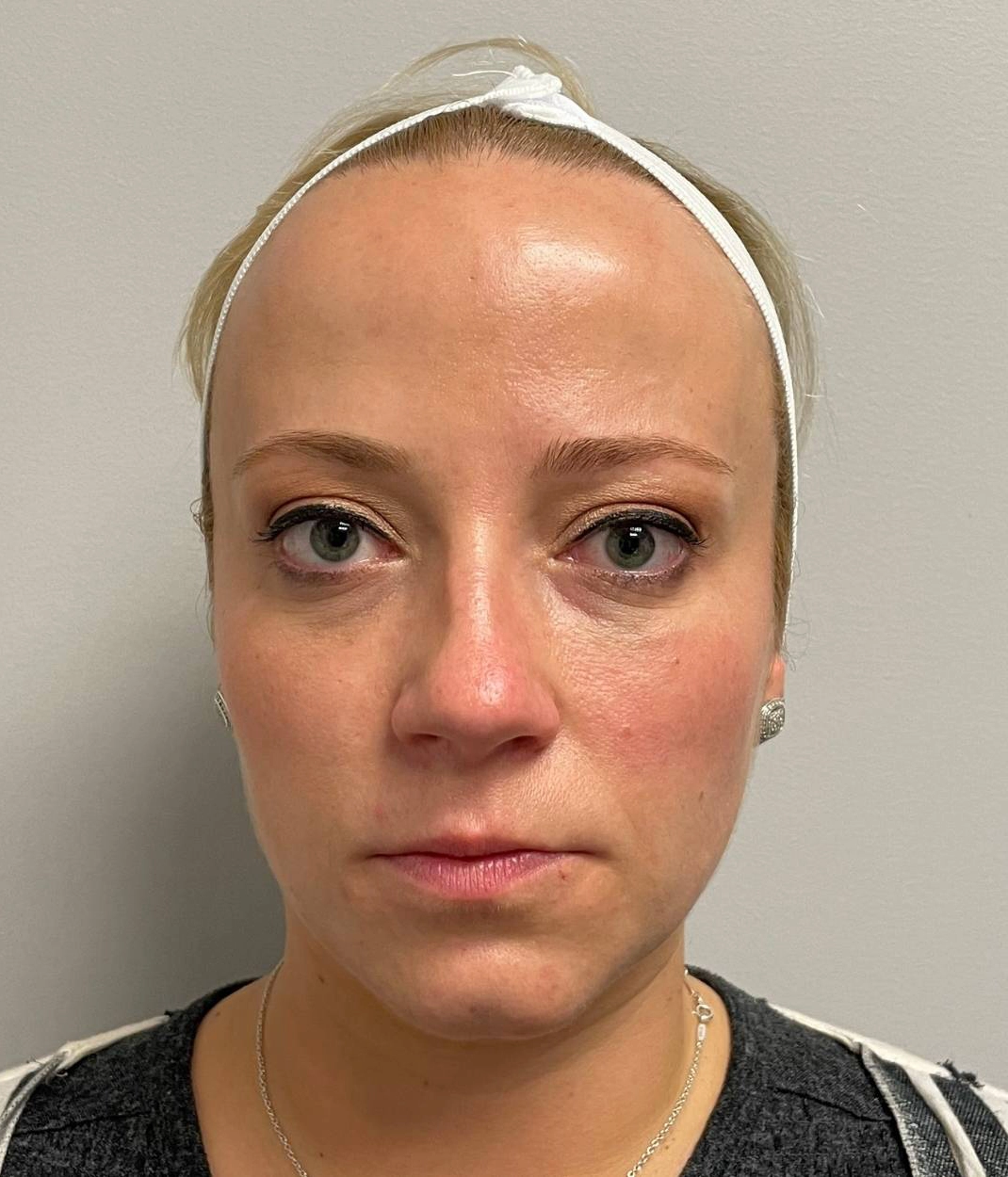 After - Facial Balancing / Fillers Patient 123