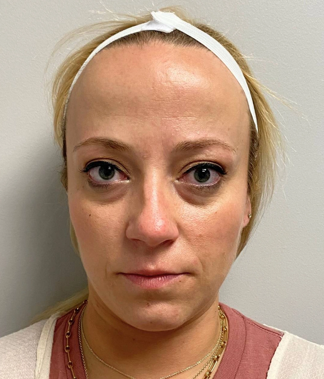 Before - Facial Balancing / Fillers Patient 123