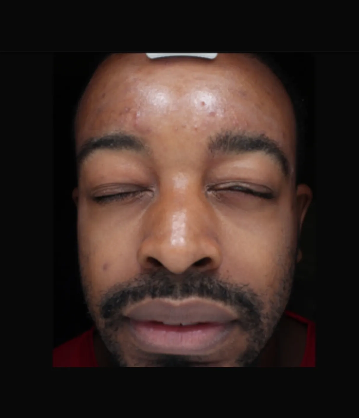 After - Chemical Peel / Melasma Patient 3