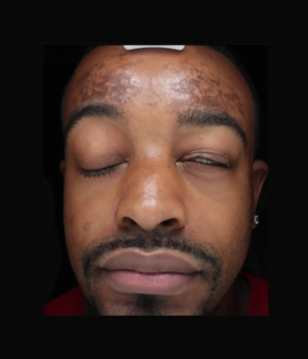 Before - Chemical Peel / Melasma Patient 3