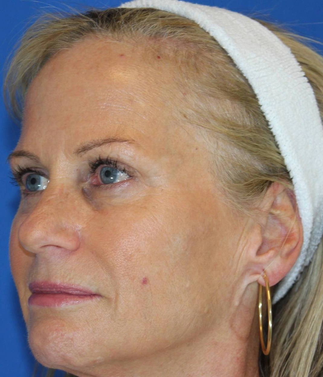 After - Microneedling + Toxins Patient 115