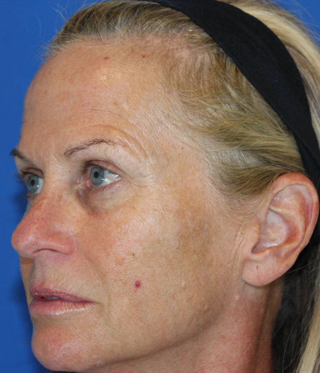 Before - Microneedling + Toxins Patient 115