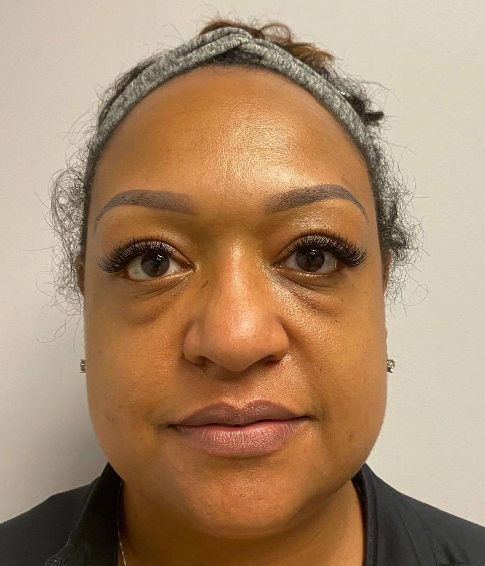 Before - Facial Balancing / Fillers Patient 107