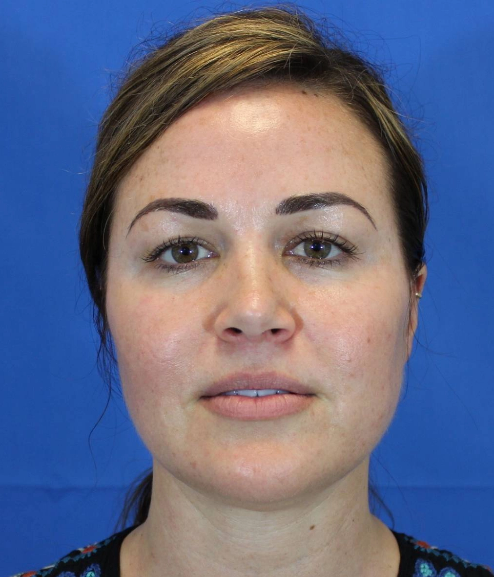 After - Facial Balancing / Fillers Patient 87