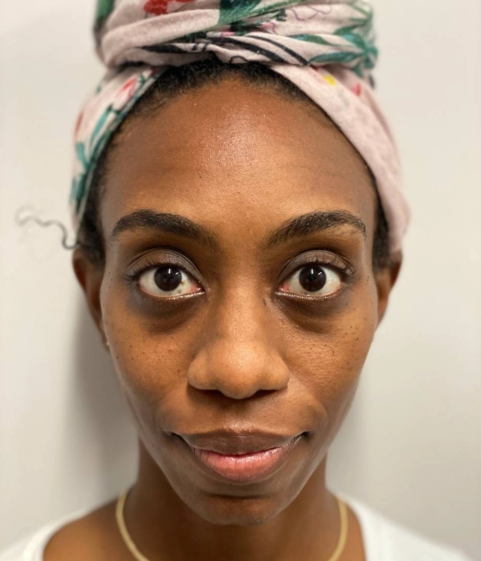Before - Facial Balancing / Fillers Patient 103