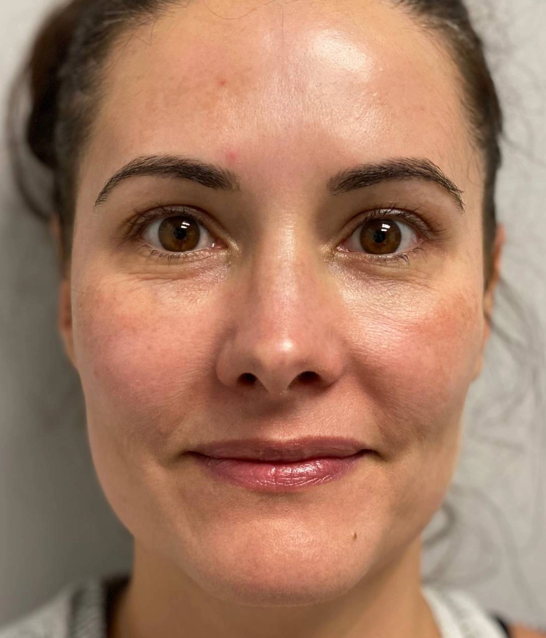 Before - Facial Balancing / Fillers Patient 105