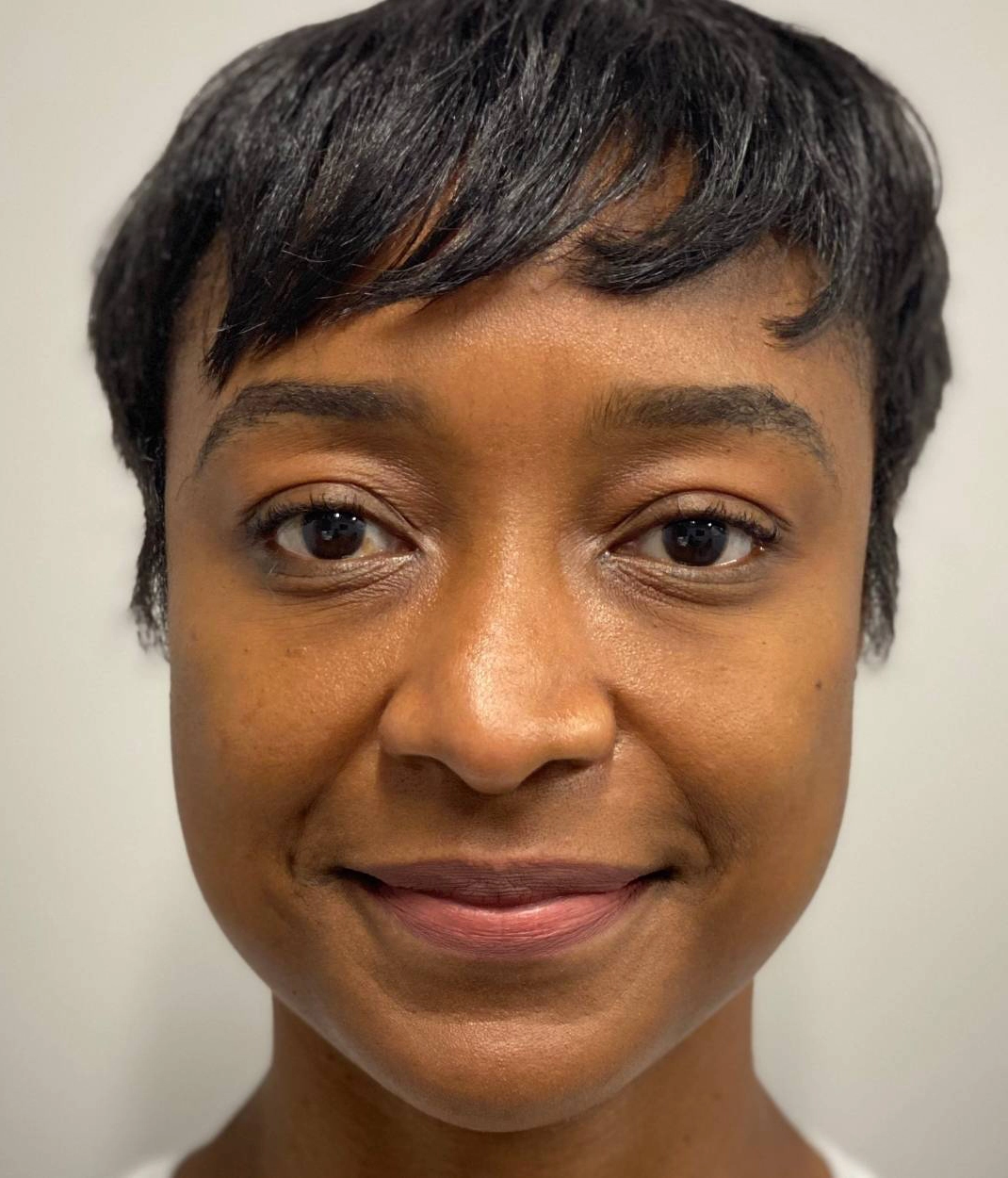 After - Facial Balancing / Fillers Patient 109