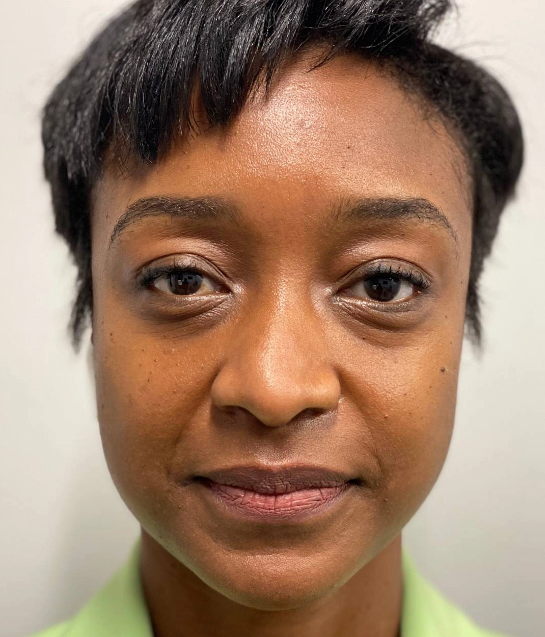 Before - Facial Balancing / Fillers Patient 109