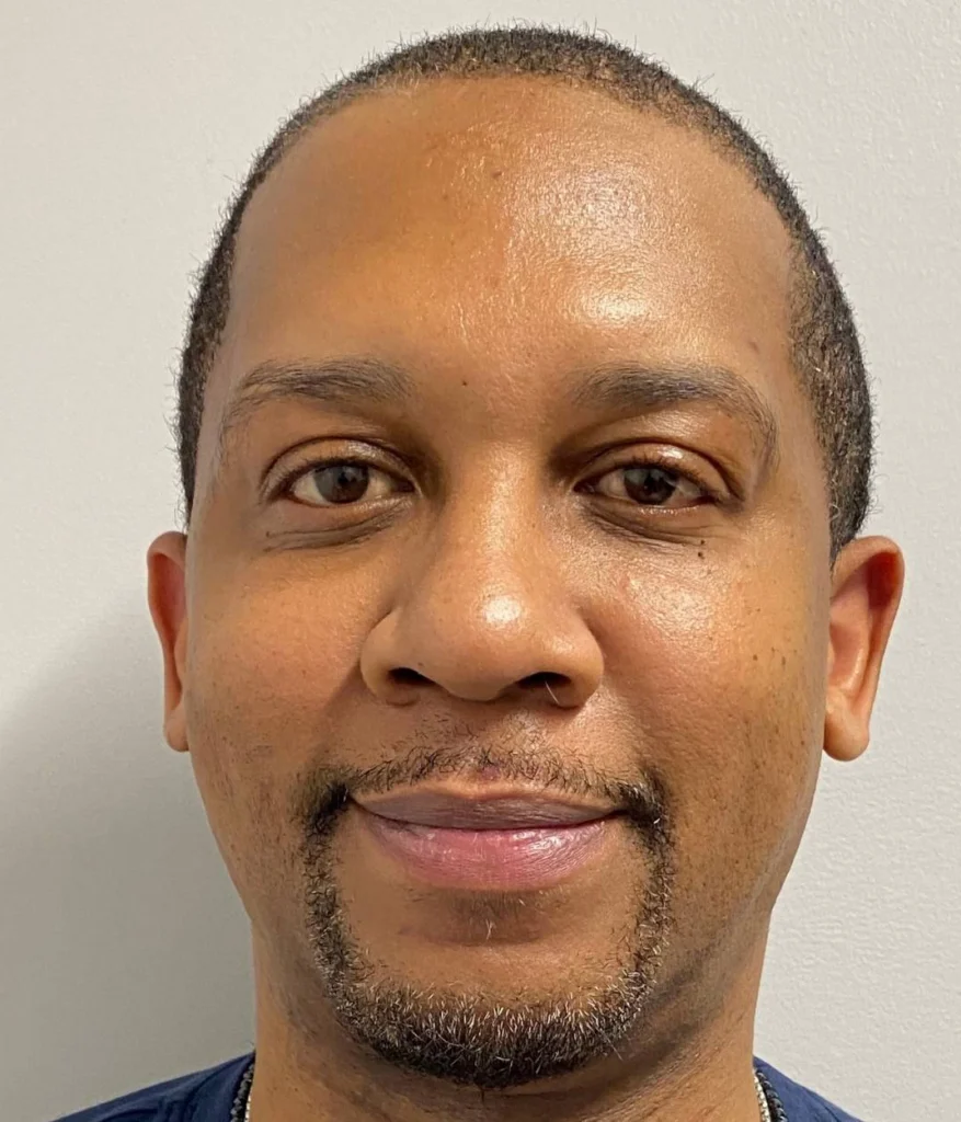 After - Facial Balancing / Fillers Patient 111