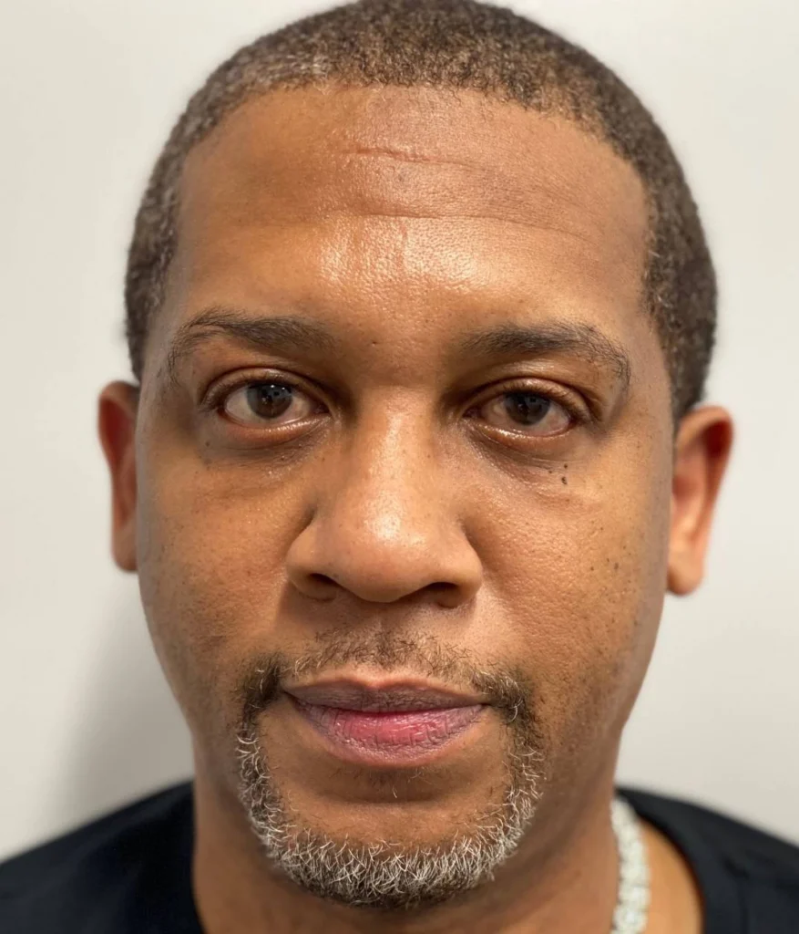 Before - Facial Balancing / Fillers Patient 111