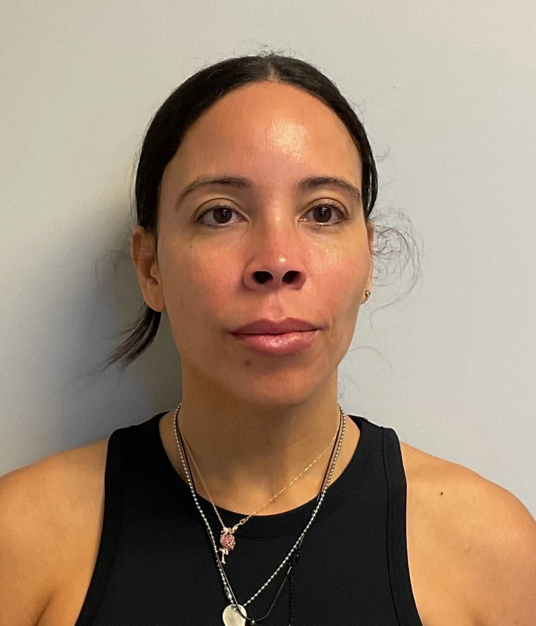 After - Facial Balancing / Fillers Patient 119