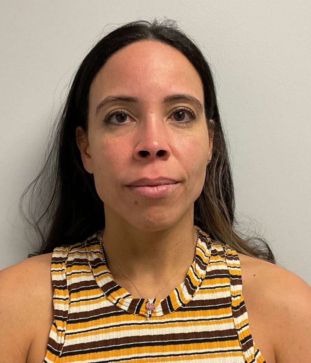 Before - Facial Balancing / Fillers Patient 119