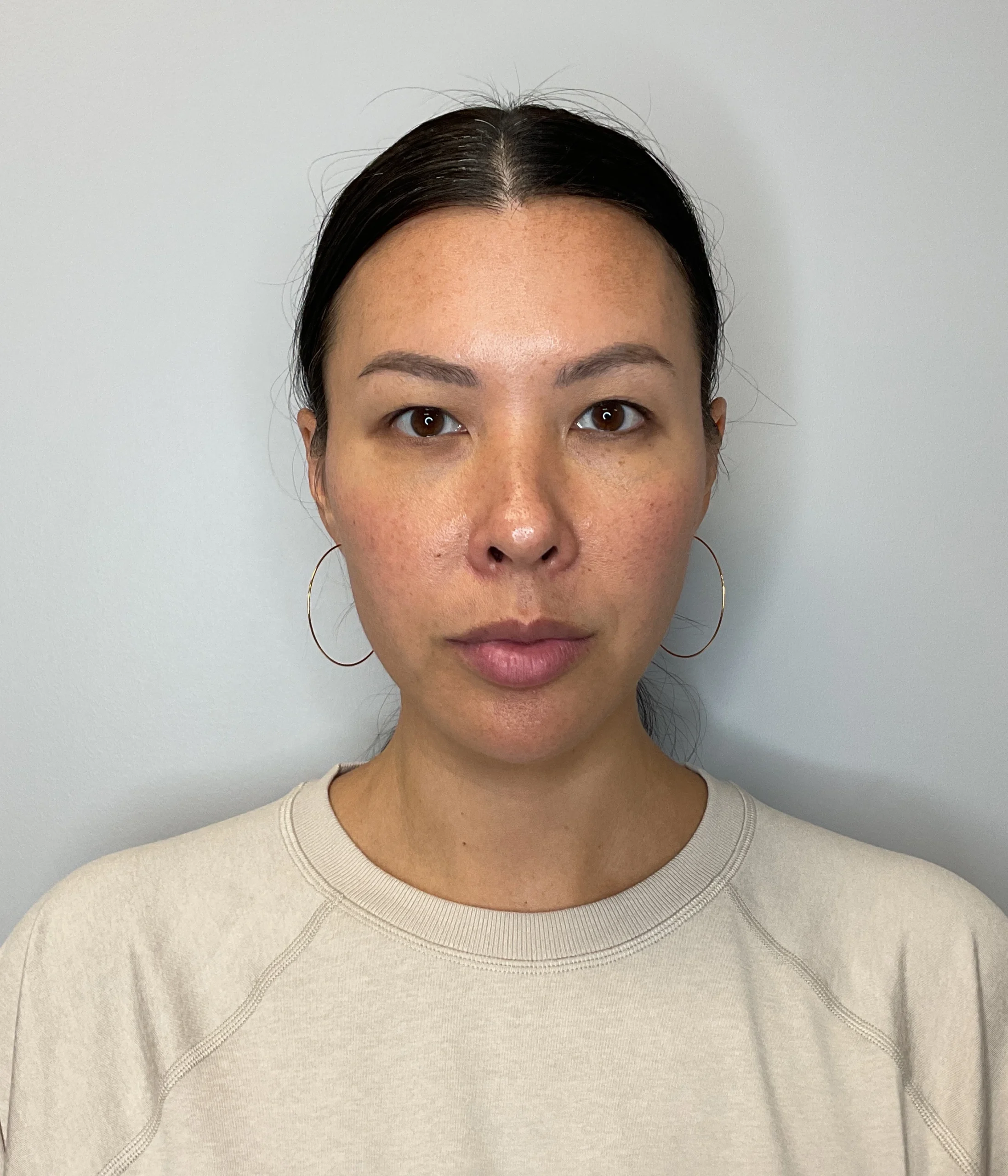 After - Facial Balancing / Fillers Patient 126