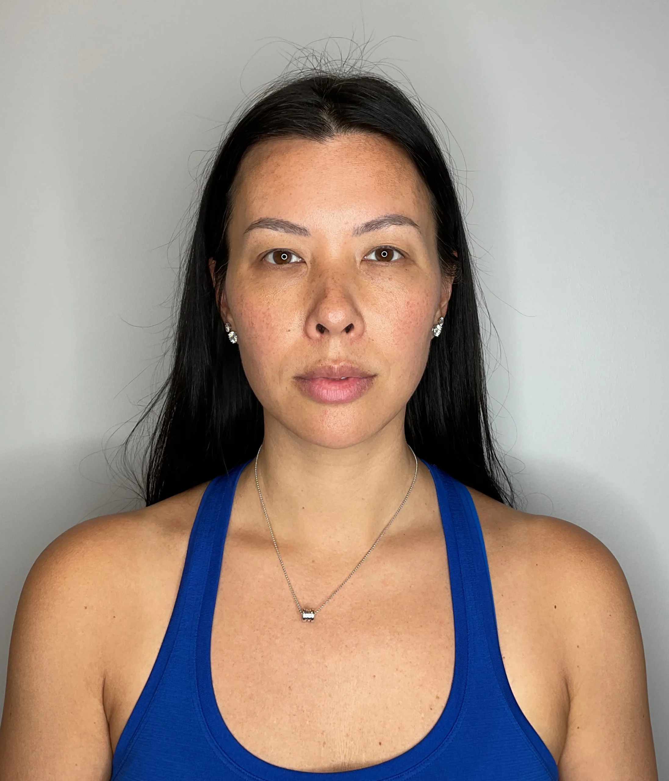 Before - Facial Balancing / Fillers Patient 126