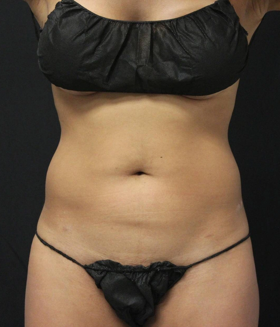 Before - Liposuction / Body Sculpting Patient 91