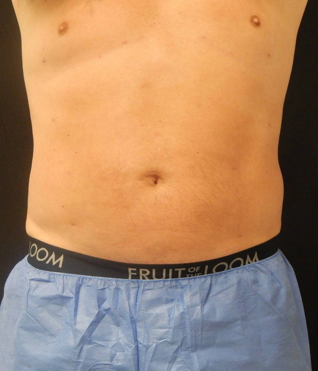 After - Liposuction / Body Sculpting Patient 95