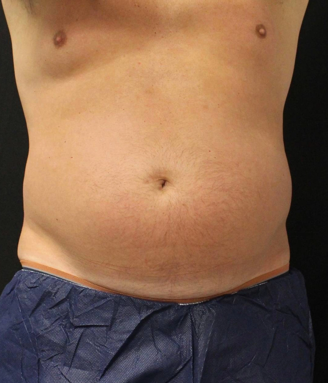 Before - Liposuction / Body Sculpting Patient 95