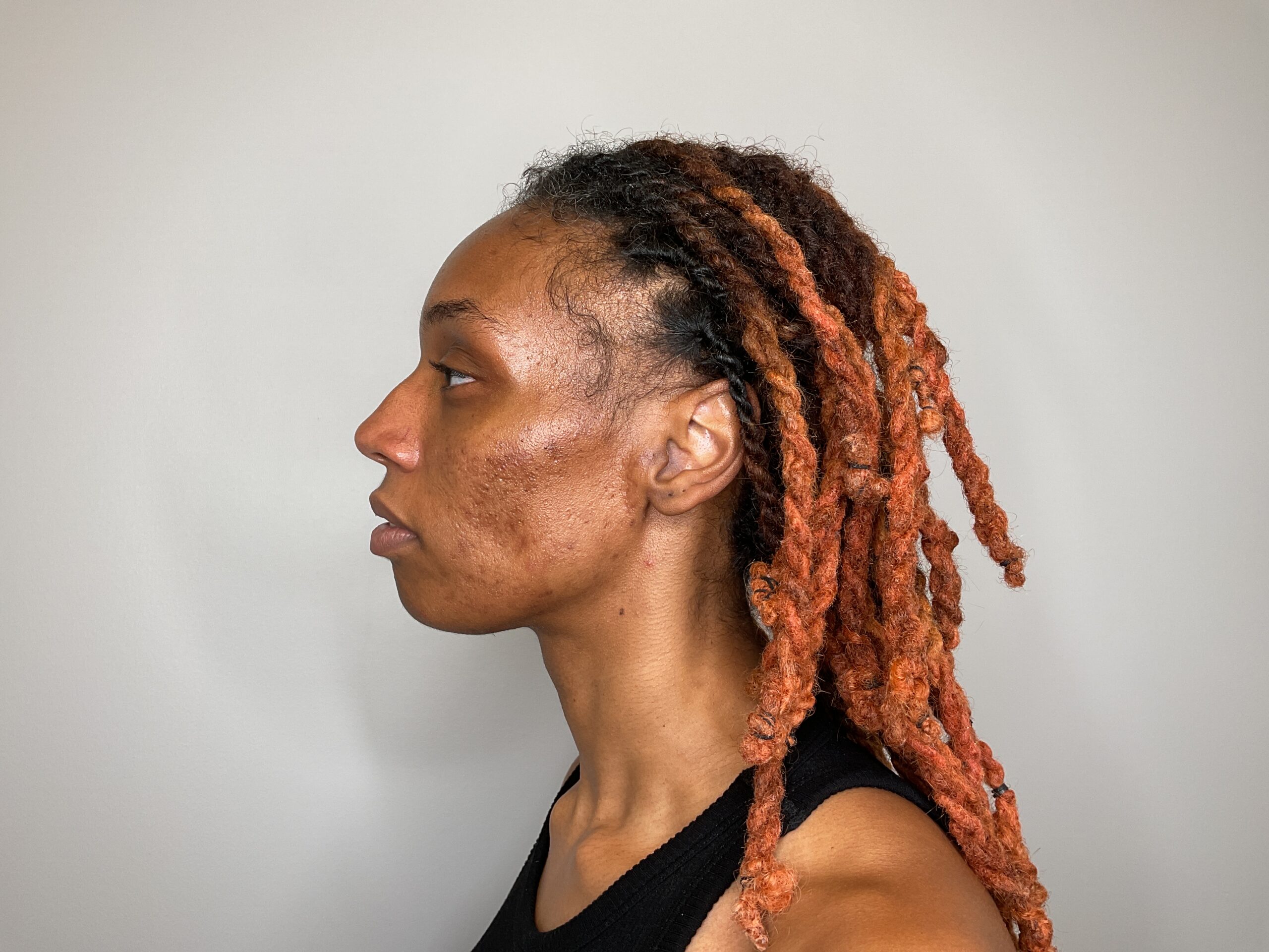 After - Acne Treatment Patient 129