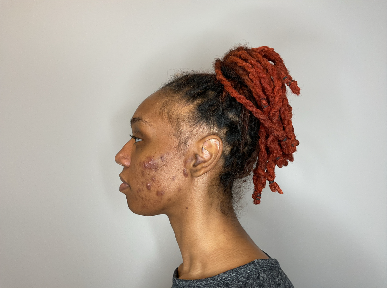Before - Acne Treatment Patient 129