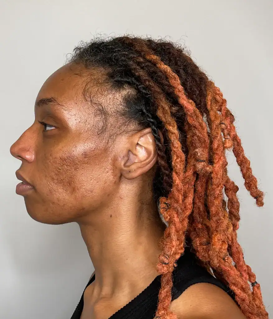 After - Acne Treatment Patient 129