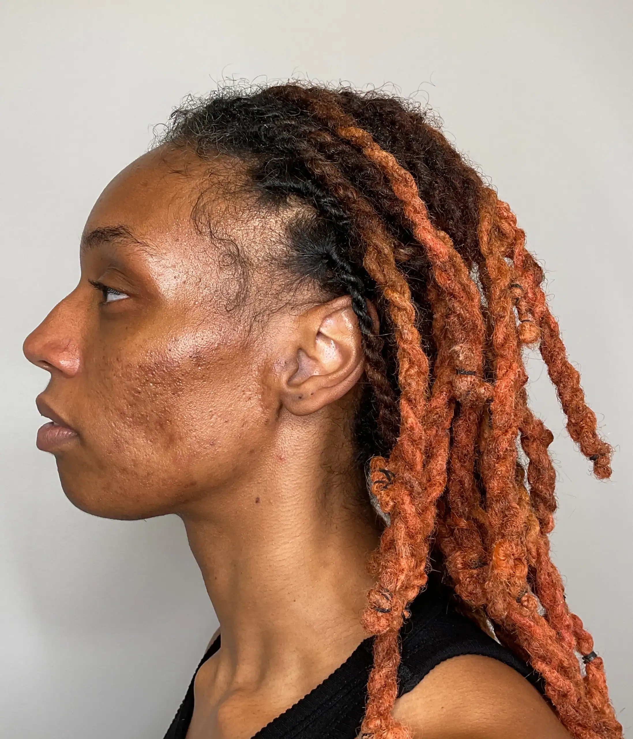 After - Acne Treatment Patient 129