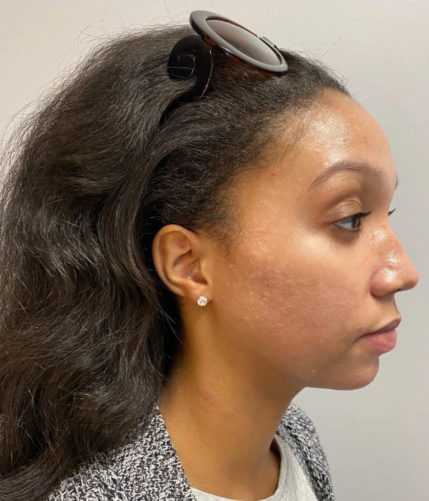 After - Acne Treatment Patient 69