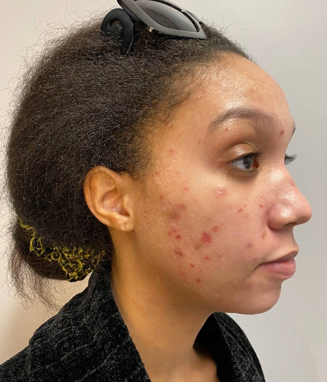 Before - Acne Treatment Patient 69