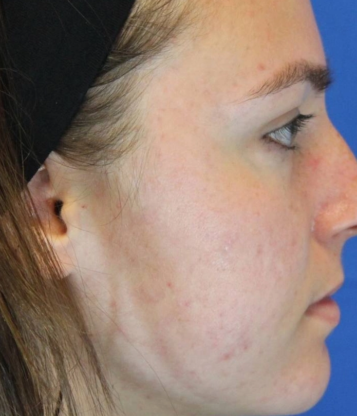 After - Acne Treatment Patient 83