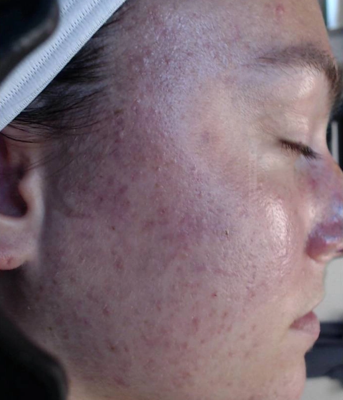 Before - Acne Treatment Patient 83